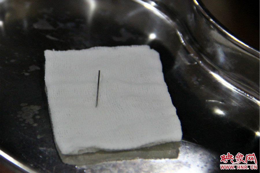 上午11點(diǎn)30分許，小龍腦中鋼針已經(jīng)成功取出。