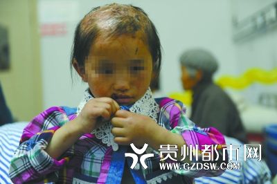 被燙傷的頭皮一直沒(méi)有愈合。