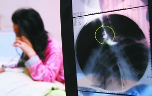 假牙上的鋼絲刺破食管，而薄薄的食道壁緊貼主動(dòng)脈血管，極易造成血管破裂