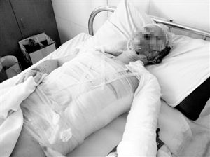 周小姐的頭、頸、軀干、四肢均被燒傷，其中面部燒傷最為嚴(yán)重。