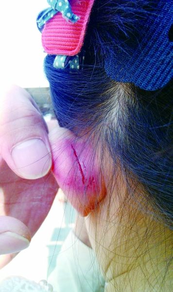女童的耳朵被老師揪裂。圖片由女童家人提供 女童的耳朵被老師揪裂。圖片由女童家人提供