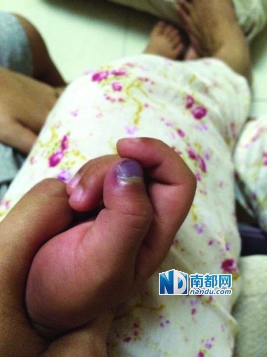 小逸手指被夾傷。