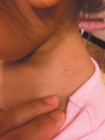 北京兩幼兒身現(xiàn)傷口稱(chēng)遭老師針扎 幼兒園否認(rèn) 北京兩幼兒身現(xiàn)傷口稱(chēng)遭老師針扎 幼兒園否認(rèn)