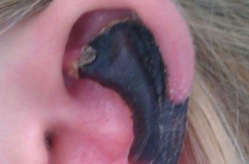 荷蘭女子旅游途中被蜘蛛咬，耳軟骨溶解變黑。