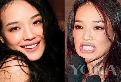 牙齒凸出，口輪肌過(guò)于松弛