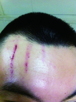 　2013年，被打者受傷照