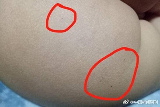 據(jù)多名紅黃藍(lán)(新天地分園)家長(zhǎng)反映，孩子腿部、屁股、腋下出現(xiàn)針眼。