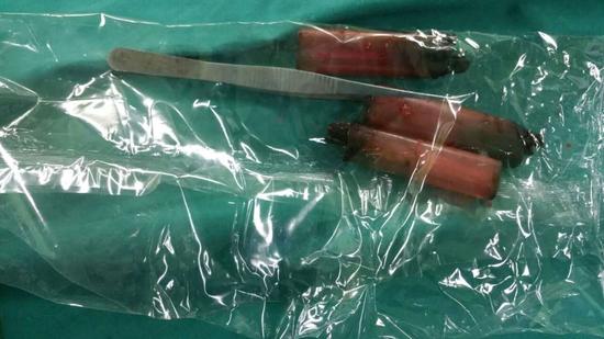 醫(yī)生從華先生胃里取出的鑷子和打火機