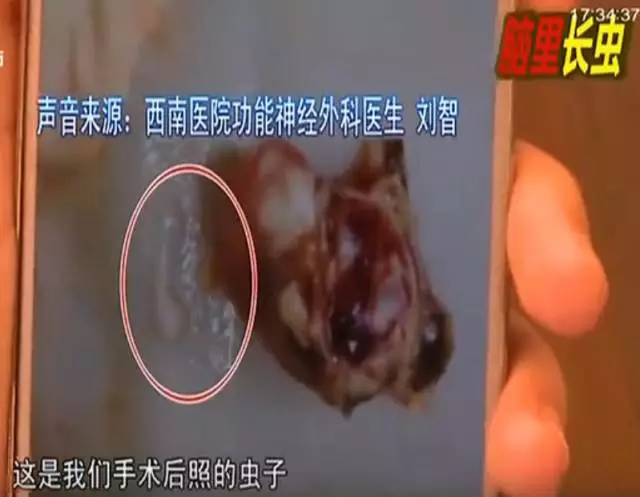 少女大腦皮層萎縮 醫(yī)生從她腦子里捉出5厘米蟲(chóng)子 少女大腦皮層萎縮 醫(yī)生從她腦子里捉出5厘米蟲(chóng)子
