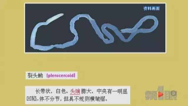 少女大腦皮層萎縮 醫(yī)生從她腦子里捉出5厘米蟲(chóng)子 少女大腦皮層萎縮 醫(yī)生從她腦子里捉出5厘米蟲(chóng)子