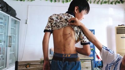 　昨日，奶西村，被打的小剛后背上條條瘀痕依然明顯。