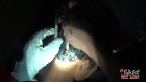 男子與妻吵架 被老婆用火鉗插入頭部4公分 男子與妻吵架 被老婆用火鉗插入頭部4公分