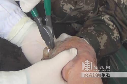 正在拆除戒指。