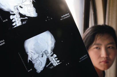 國內(nèi)醫(yī)院CT顯示，如今靳魏坤的鼻子假體是歪的，連下巴也是歪的